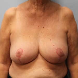 After Image: Breast Reduction – Dr. Howell