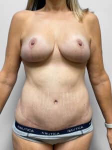 After Image: Mommy Makeover – Dr. Howell