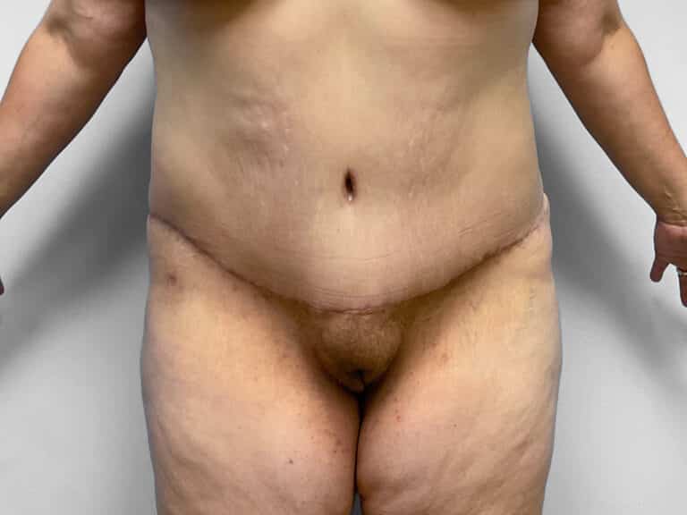 After Image: Tummy Tuck – Dr. Howell - front