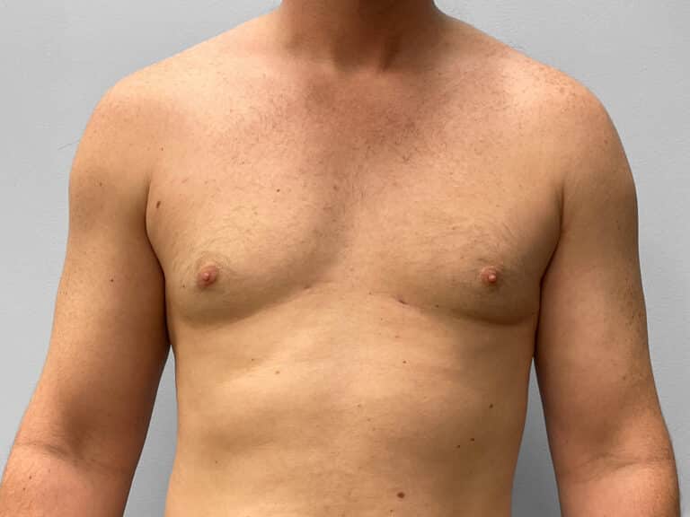 After Image: Gynecomastia Correction – Dr. Howell - front