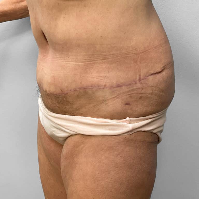 After Image: Abdominoplasty – Dr. Howell - left-front-oblique