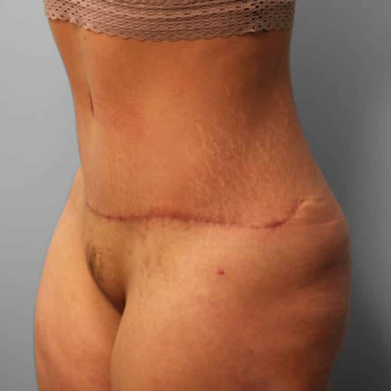 After Image: Abdominoplasty – Dr. Howell - left-front-oblique