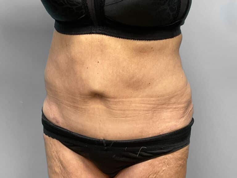 After Image: Tummy Tuck – Dr. Howell - left-front-oblique