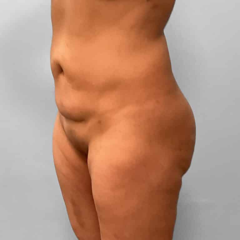 After Image: Liposuction – Dr. Howell - left-front-oblique