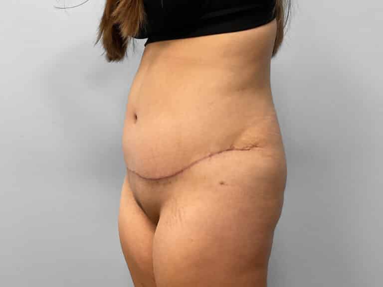 After Image: Tummy Tuck – Dr. Howell - left-front-oblique
