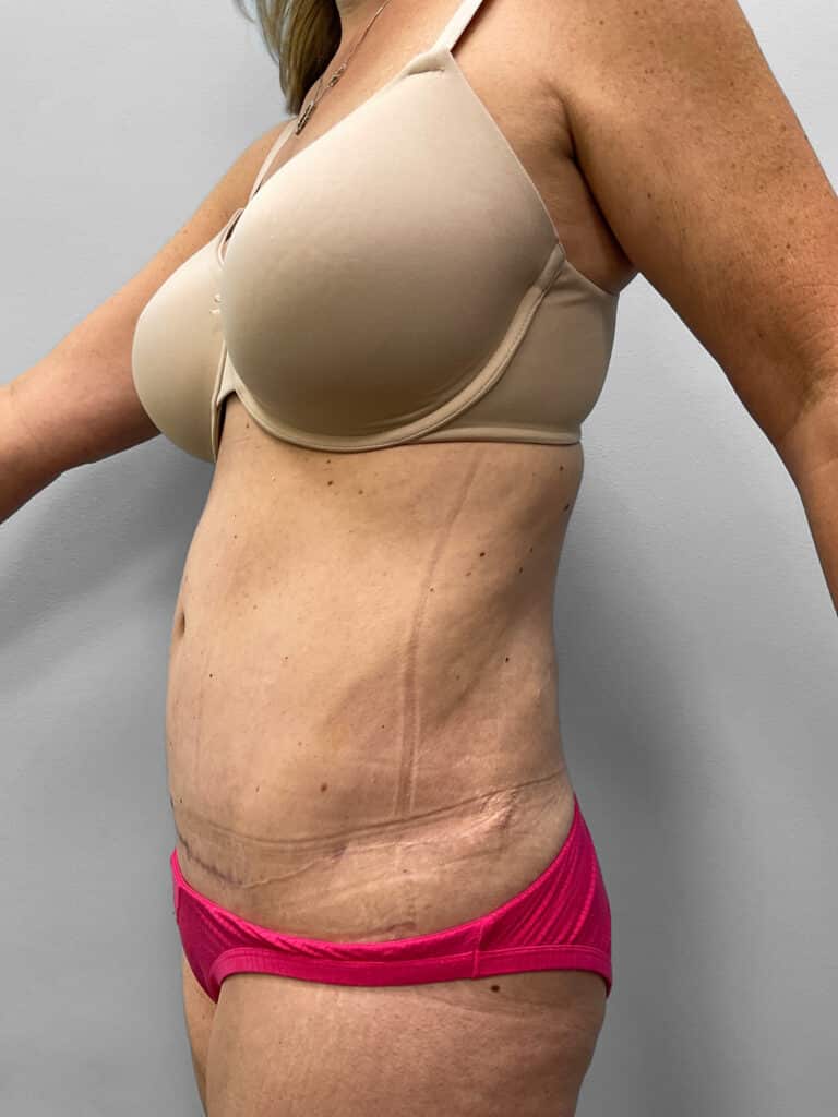 After Image: Mommy Makeover – Dr. Howell - left-front-oblique