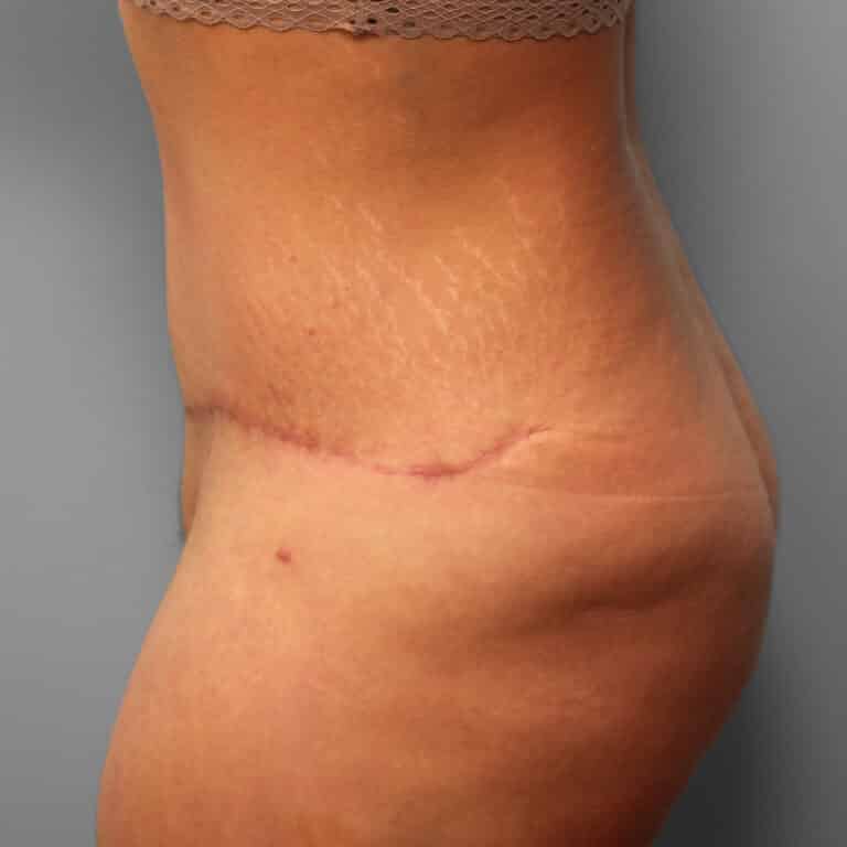 After Image: Abdominoplasty – Dr. Howell - left-side