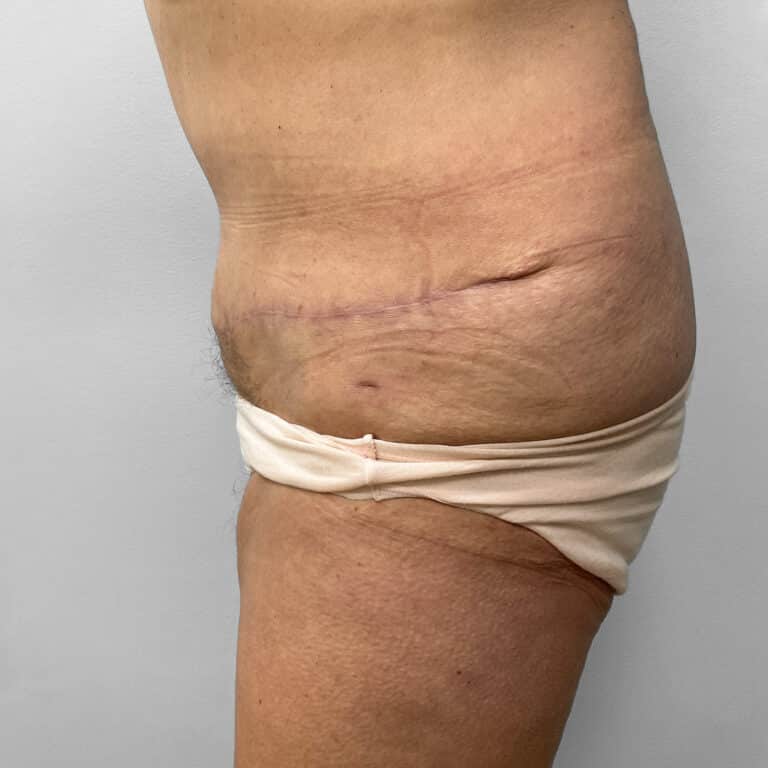 After Image: Abdominoplasty – Dr. Howell - left-side