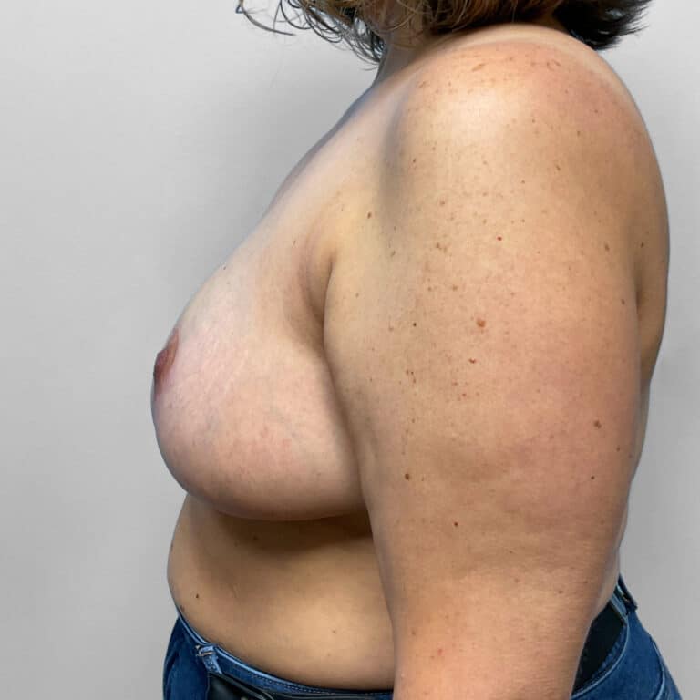 After Image: Mommy Makeover – Dr. Howell - left-side