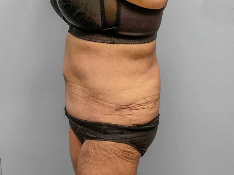 After Image: Tummy Tuck – Dr. Howell - left-side