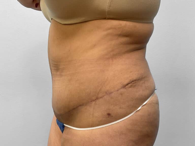 After Image: Abdominoplasty – Dr. Howell - left-side