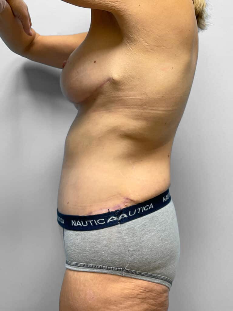 After Image: Mommy Makeover – Dr. Howell - left-side
