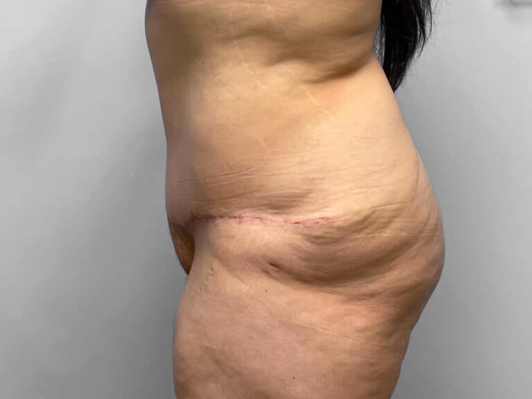 After Image: Tummy Tuck – Dr. Howell -