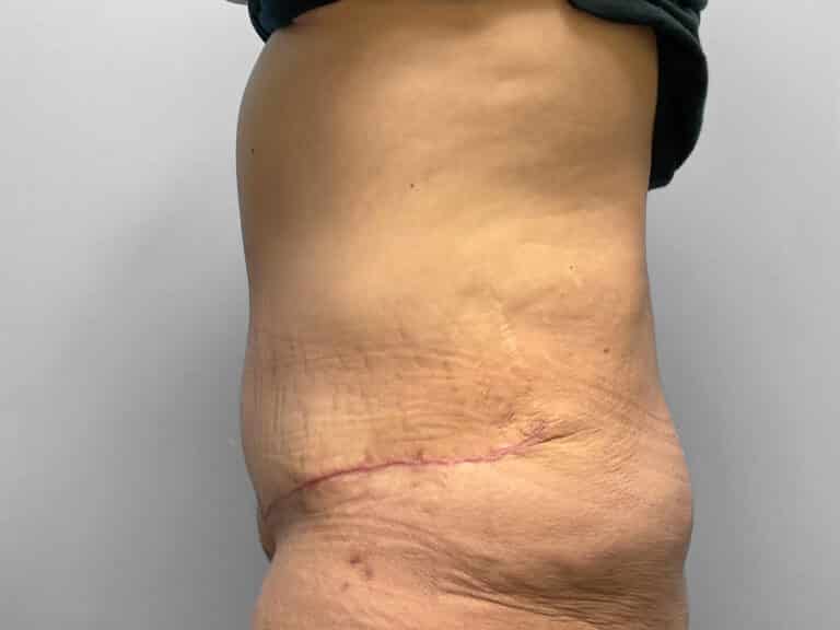 After Image: Abdominoplasty – Dr. Howell - left-side