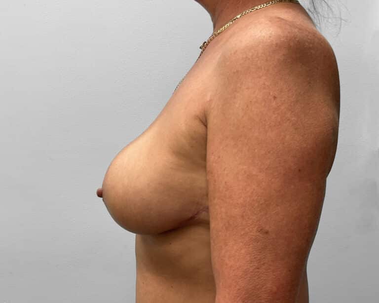 After Image: Breast Lift and Implant Removal – Dr. Howell - left-side