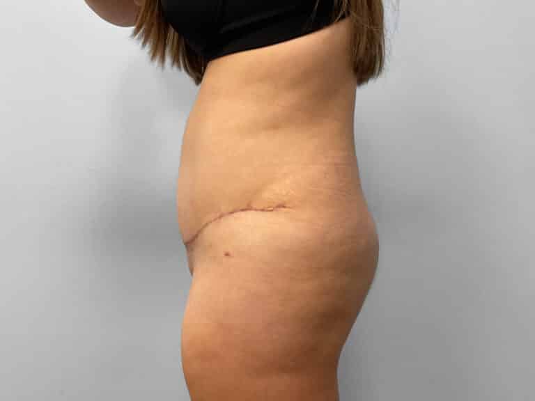 After Image: Tummy Tuck – Dr. Howell - left-side