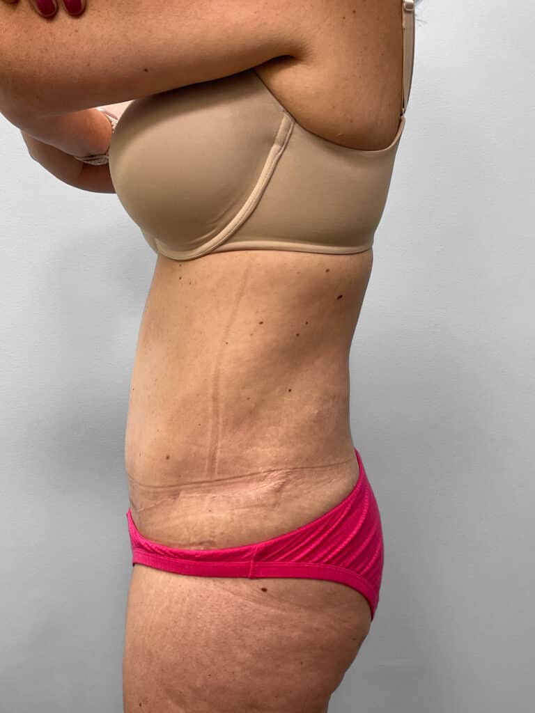 After Image: Mommy Makeover – Dr. Howell - left-side