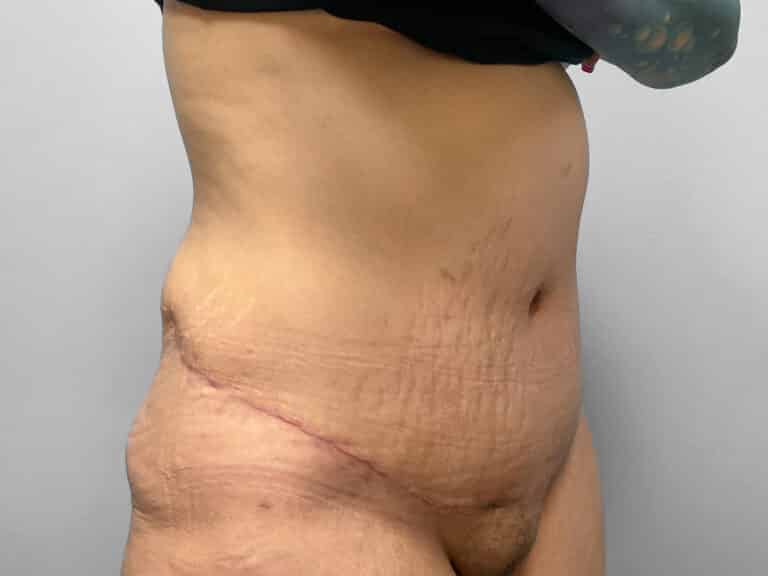 After Image: Abdominoplasty – Dr. Howell - right-front-oblique