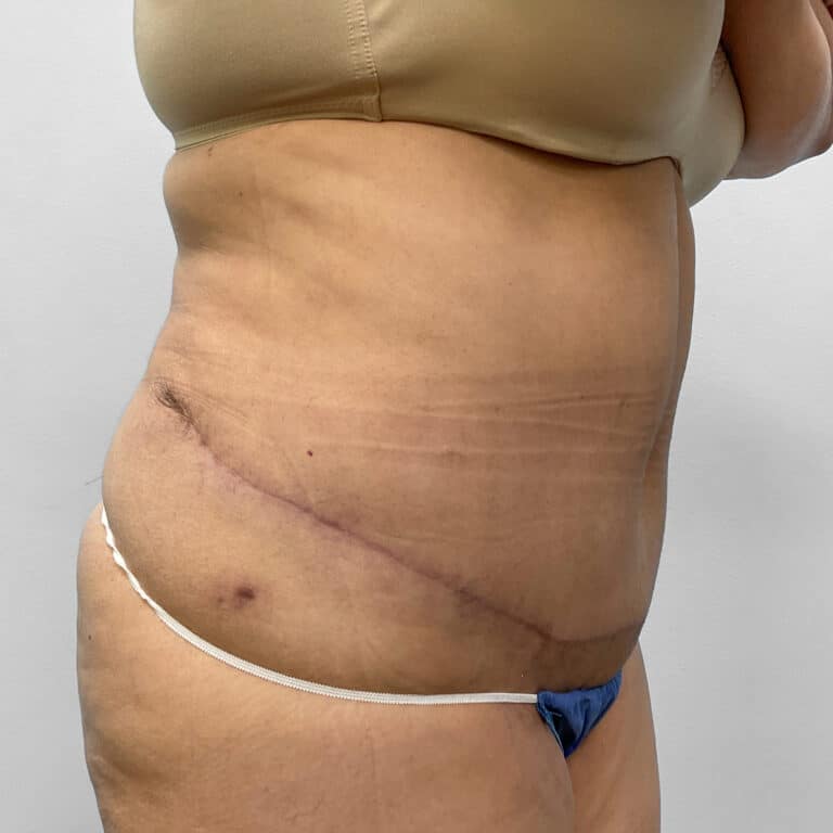 After Image: Abdominoplasty – Dr. Howell - right-front-oblique