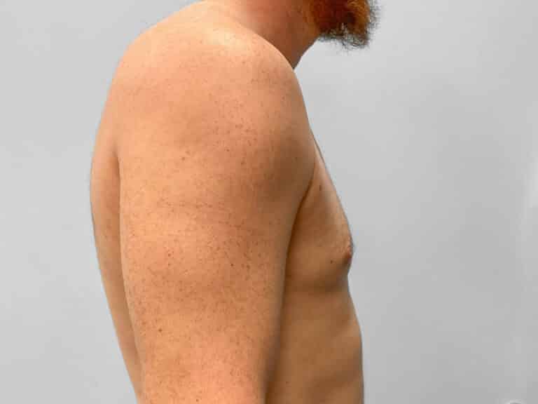 After Image: Gynecomastia Correction – Dr. Howell - right-side