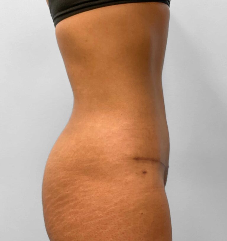 After Image: Umbilical Float Tummy Tuck – Dr. Howell - right-side