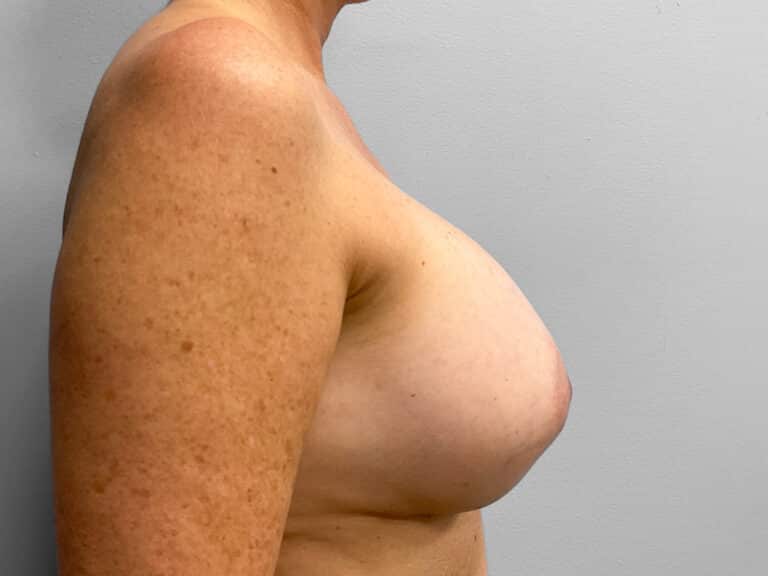 After Image: Breast Implant Exchange – Dr. Howell - right-side