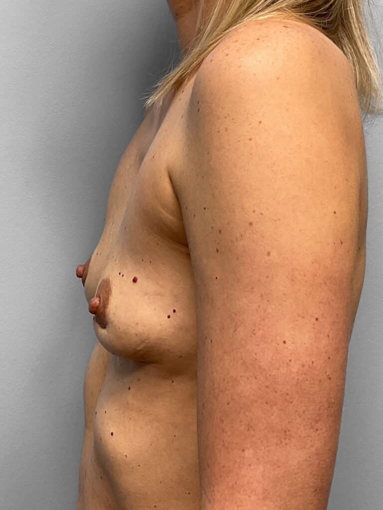 After Image: Breast Implant Removal – Dr. Howell - left-side