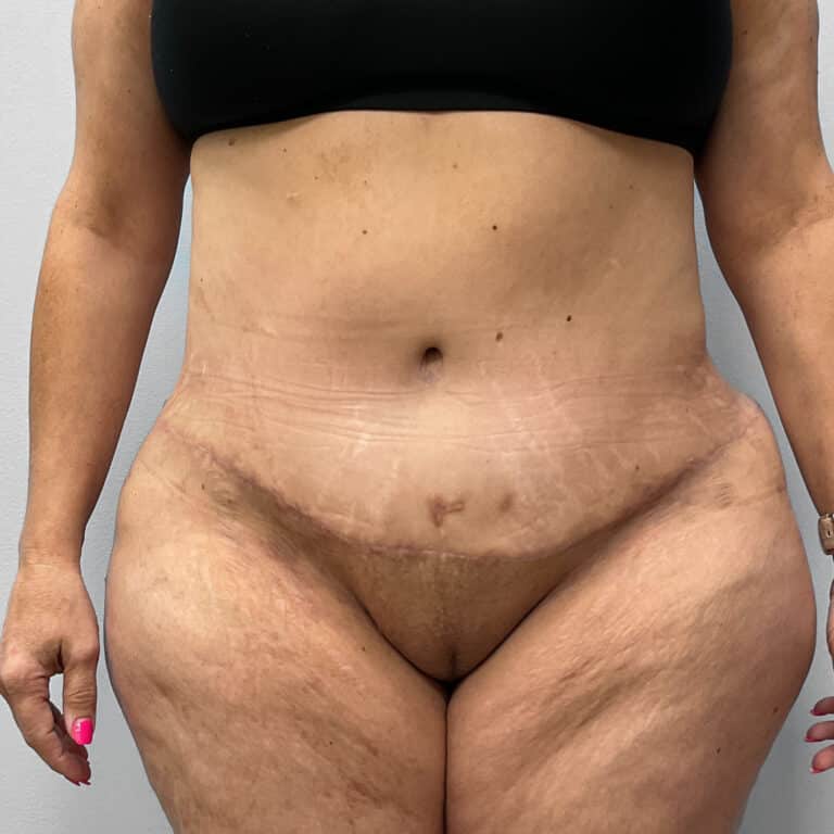 After Image: Mommy Makeover – Dr. Howell - front