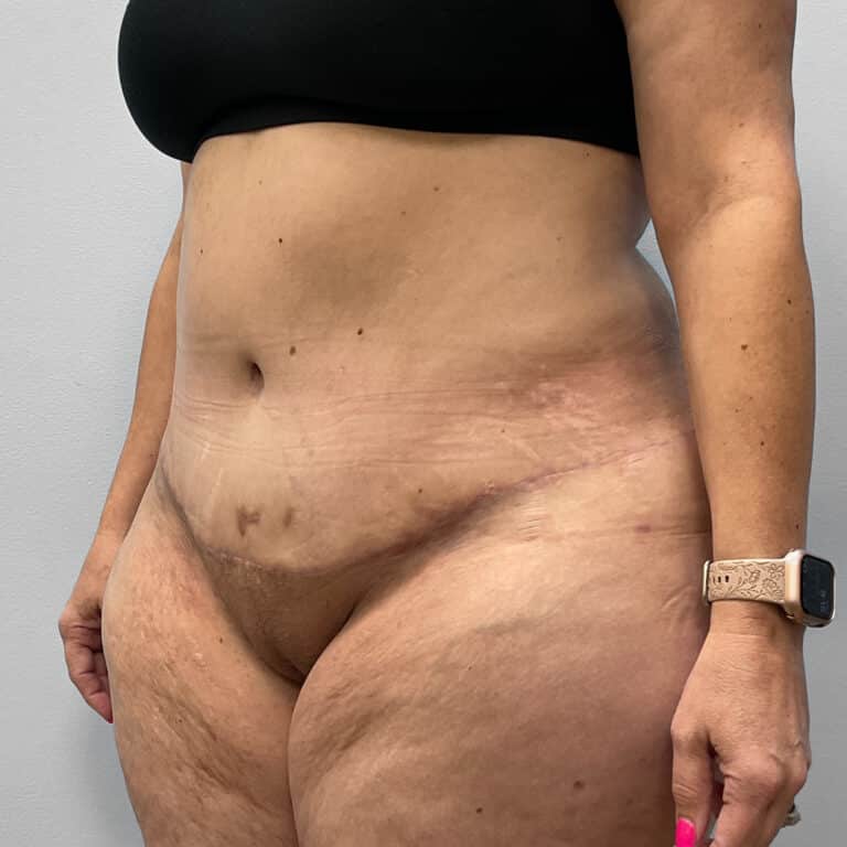 After Image: Mommy Makeover – Dr. Howell - left-front-oblique