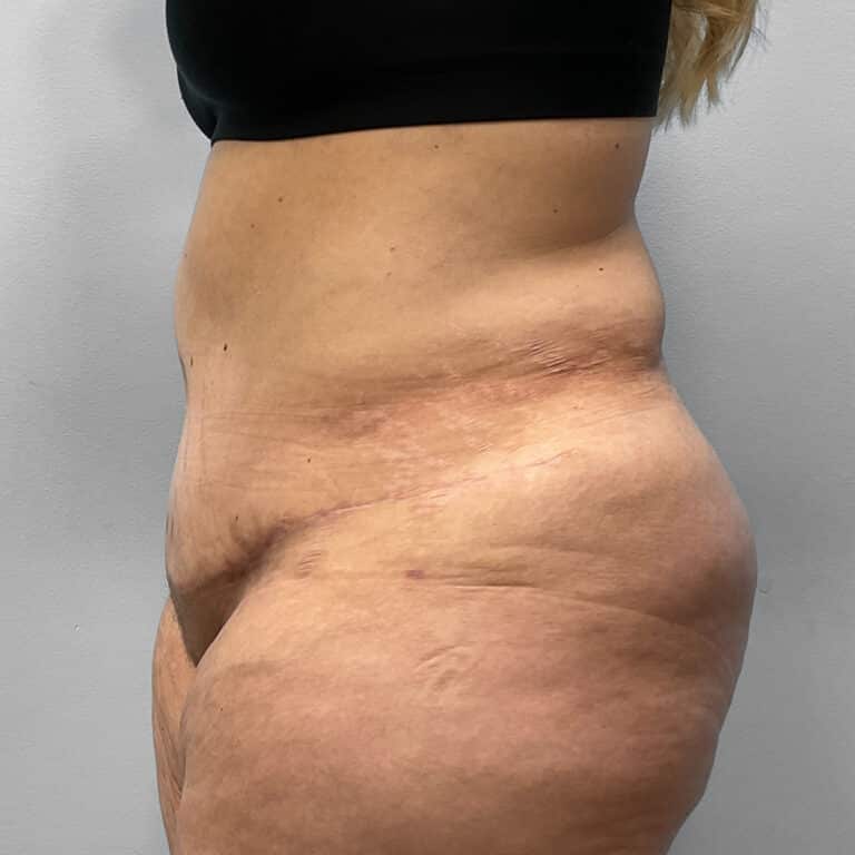 After Image: Mommy Makeover – Dr. Howell - left-side