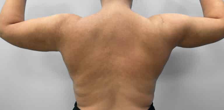After Image: Liposuction – Dr. Howell - back