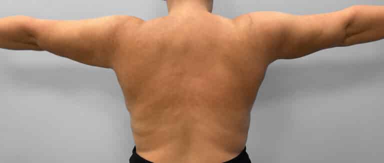 After Image: Liposuction – Dr. Howell - back
