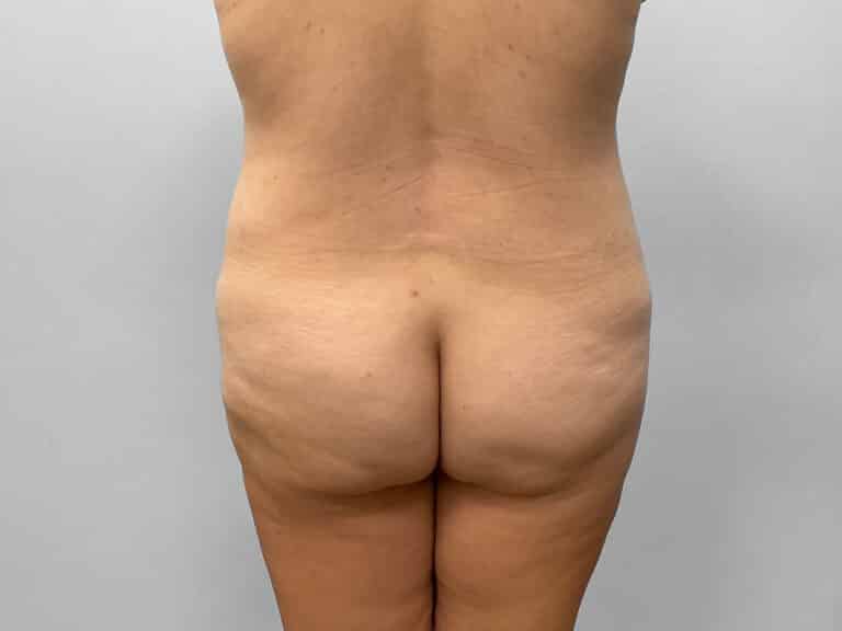 Before Image: Tummy Tuck – Dr. Howell - back