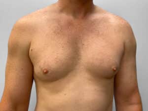 Before Image: Gynecomastia Correction – Dr. Howell