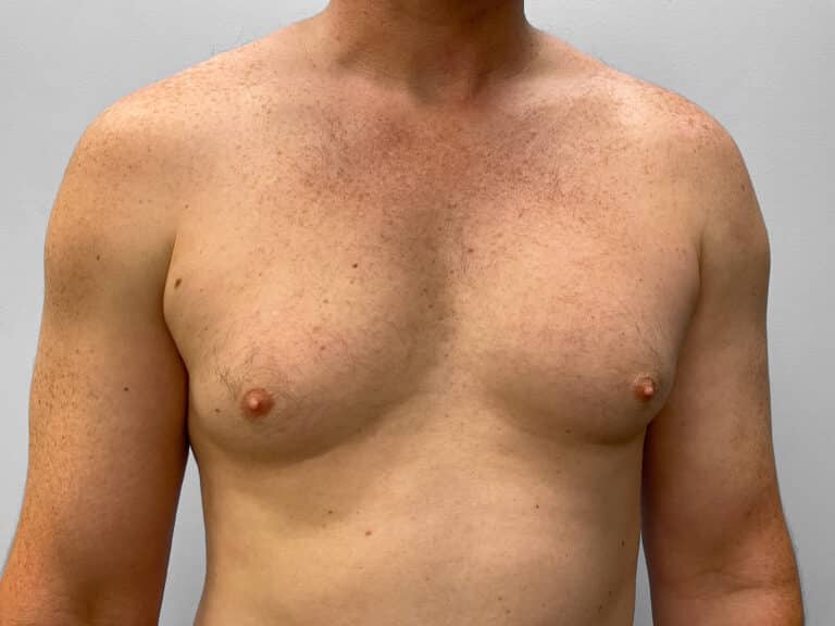 Before Image: Gynecomastia Correction – Dr. Howell - front