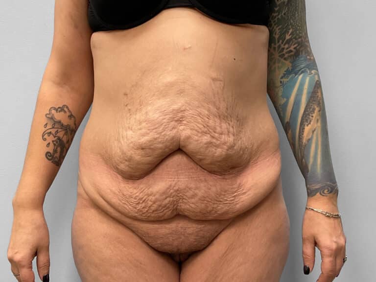 Before Image: Abdominoplasty – Dr. Howell - front
