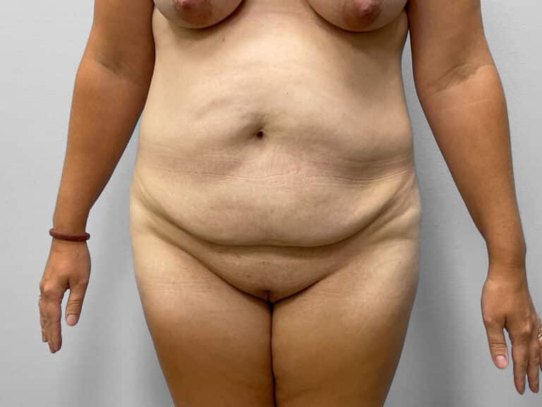 Before Image: Tummy Tuck – Dr. Howell - front