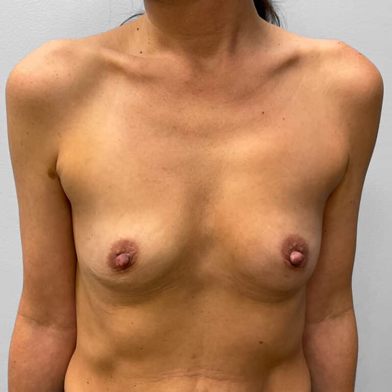 Before Image: Breast Augmentation – Dr. Howell - front