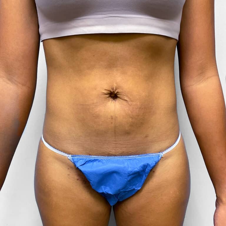 Before Image: Umbilical Float Tummy Tuck – Dr. Howell - front