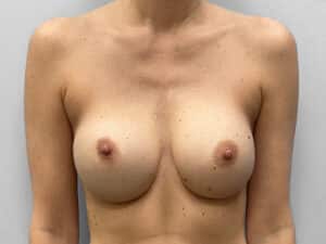 Before Image: Breast Implant Removal – Dr. Howell