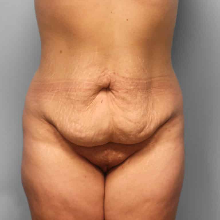 Before Image: Abdominoplasty – Dr. Howell - front