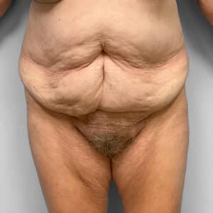 Before Image: Abdominoplasty – Dr. Howell