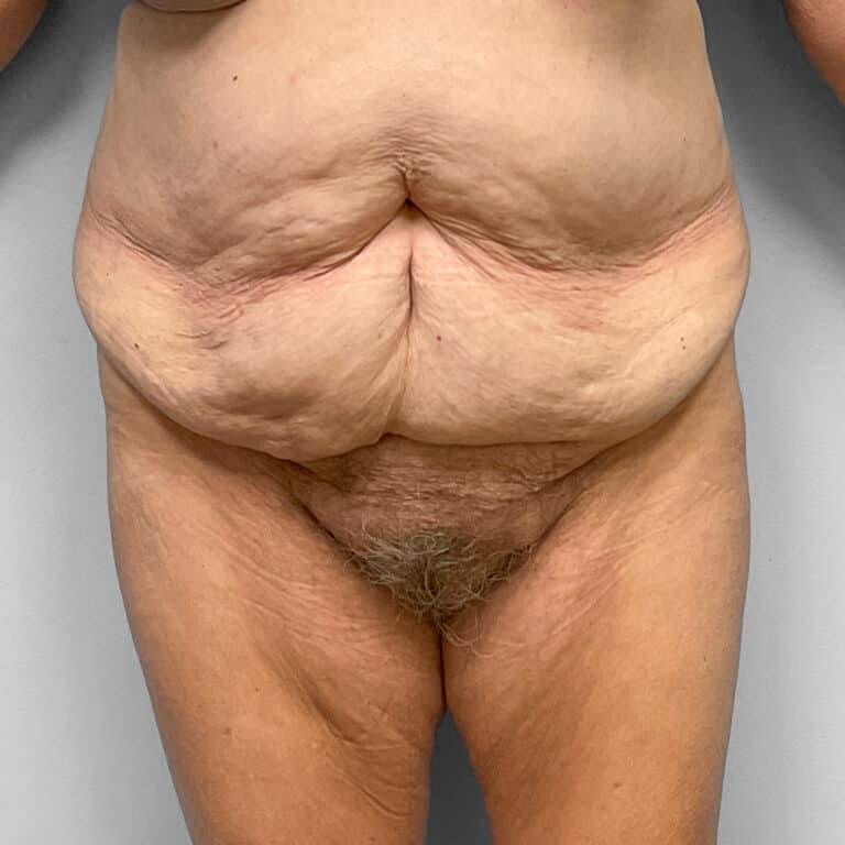 Before Image: Abdominoplasty – Dr. Howell - front