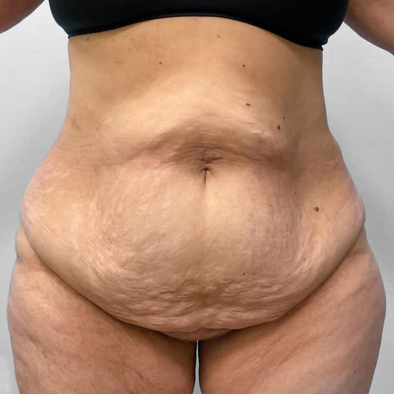Before Image: Mommy Makeover – Dr. Howell - front