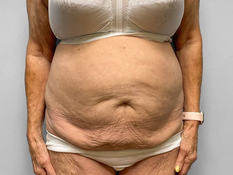 Before Image: Tummy Tuck – Dr. Howell - front