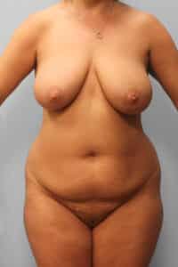 Before Image: Mommy Makeover – Dr. Howell