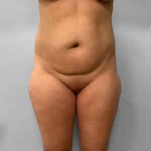 Before Image: Liposuction – Dr. Howell