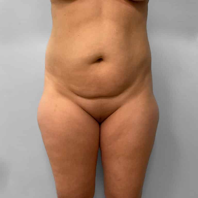 Before Image: Liposuction – Dr. Howell - front