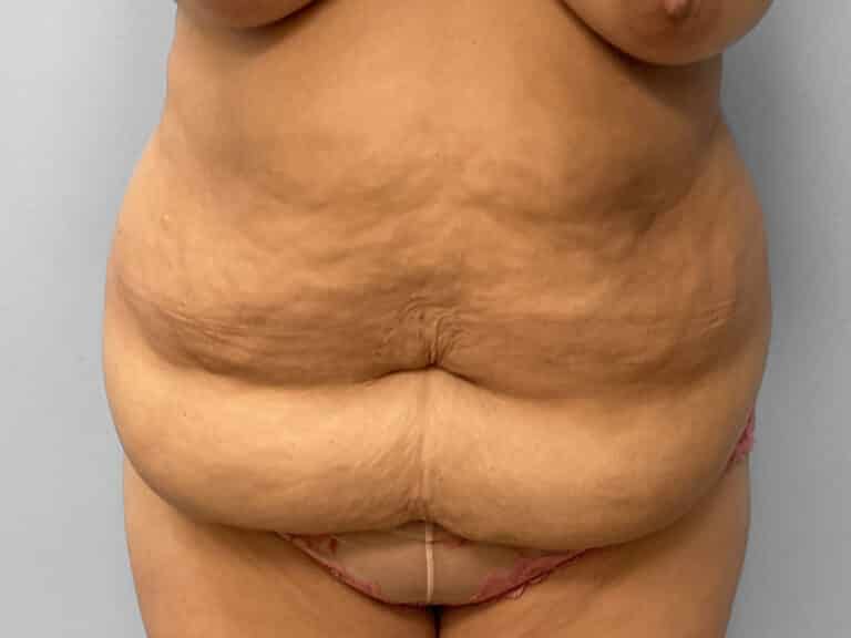 Before Image: Abdominoplasty – Dr. Howell - front