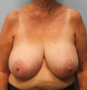 Before Image: Breast Reduction – Dr. Howell
